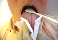 乾いたガーゼで舌の先を保持し、奥から手前に舌ブラシをやさしく引くようにして除去する