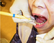 歯科衛生士による歯石除去（専門的所見が必要）