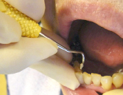 除去される歯石