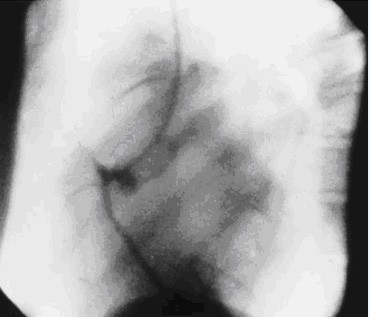 ソーンズが偶然写した右冠動脈(Ryan TJ : J Am Coll Cardiol 31, 4B, 89B-96B, 1998)