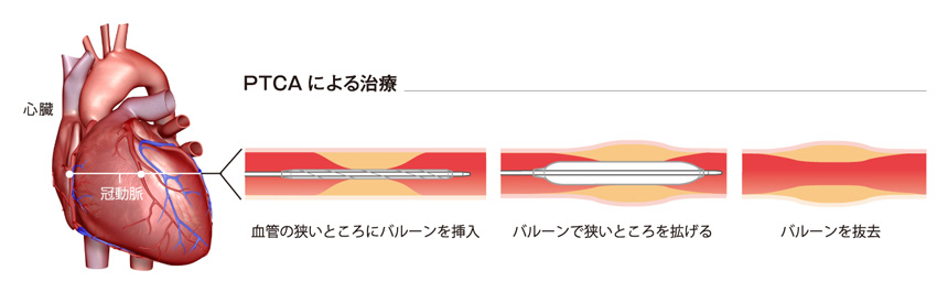 PTCAによる治療