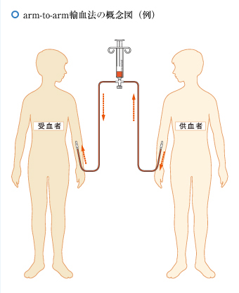 手臂对手臂输血方法概念图（示例）