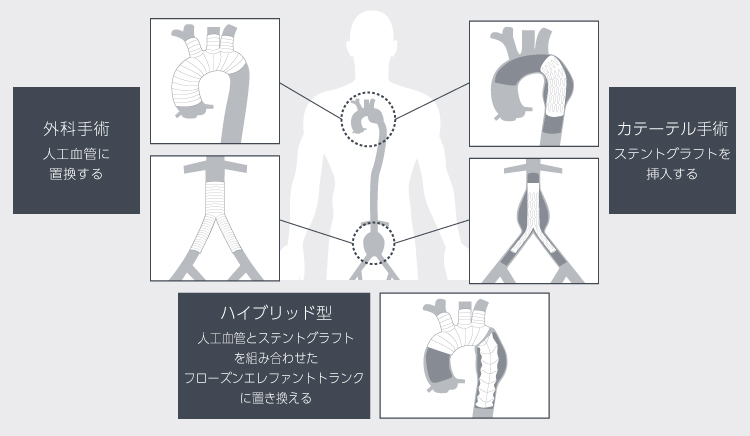 人工血管置換術およびステントグラフト内挿術とは？