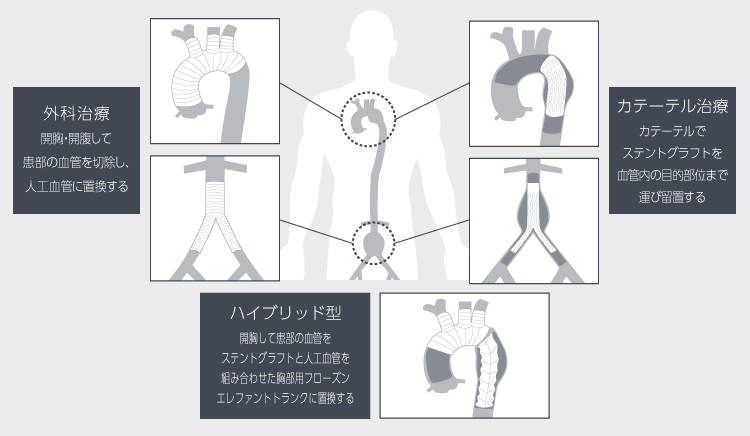 人工血管置換術およびステントグラフト内挿術とは？