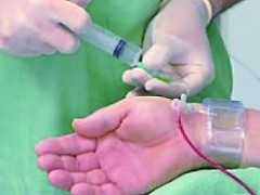 TRI(手首からのカテーテル治療)のイメージ