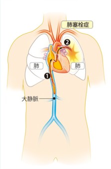 肺塞栓症の発症過程