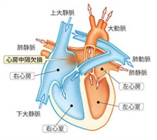 心房中隔欠損症の図