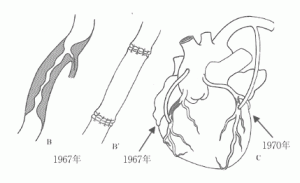 ファバローロが実施した冠動脈手術の変遷動脈硬化巣がある冠動脈の部分（B）を切除し、代わりに静脈を吻合する(B’)。