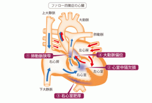ファロー四徴症の心臓