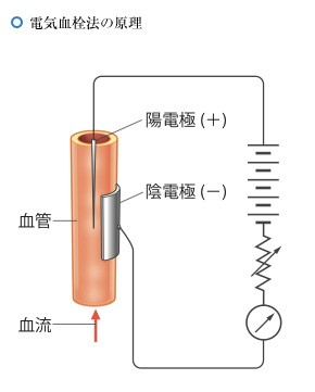 電気血栓法の原理