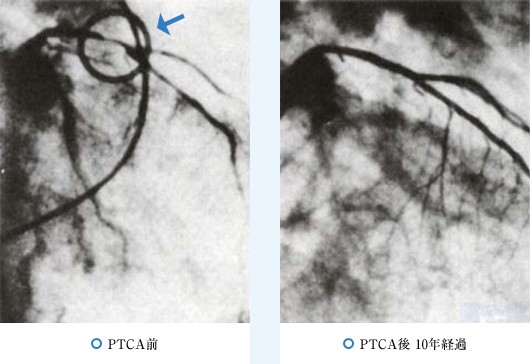 PTCA前/PTCA後 10年経過