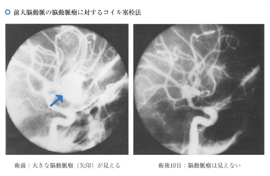 前大脳動脈の脳動脈瘤に対するコイル塞栓法