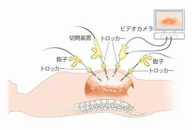 現在の腹腔鏡下手術（例）